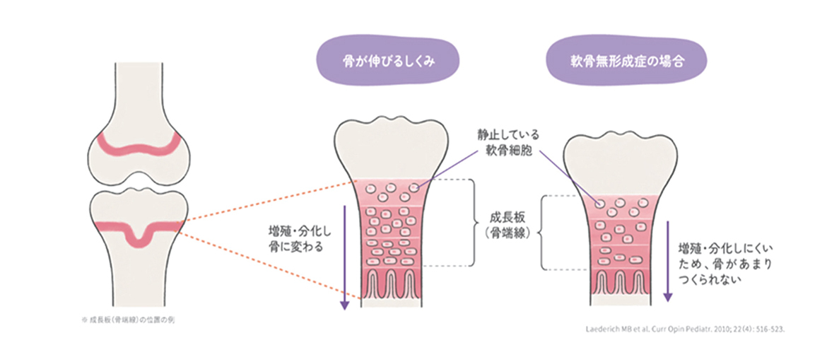 骨が伸びる仕組みと軟骨無形成症